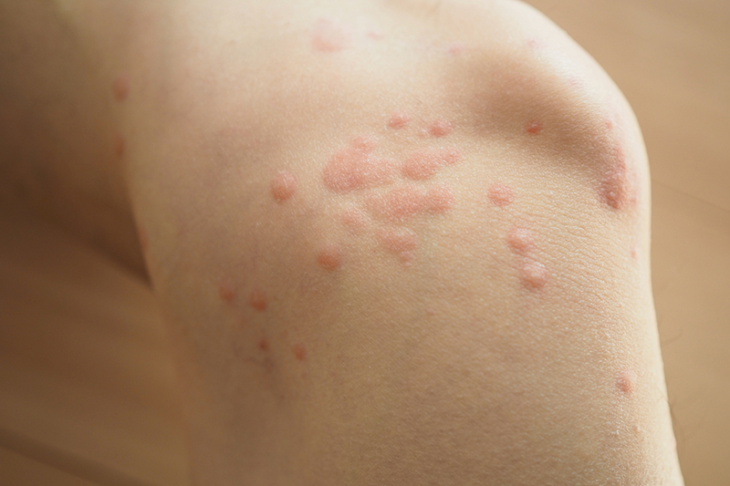 蕁麻疹（じんましん）