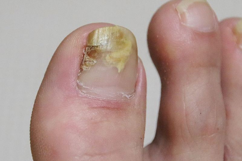 水虫（足白癬）