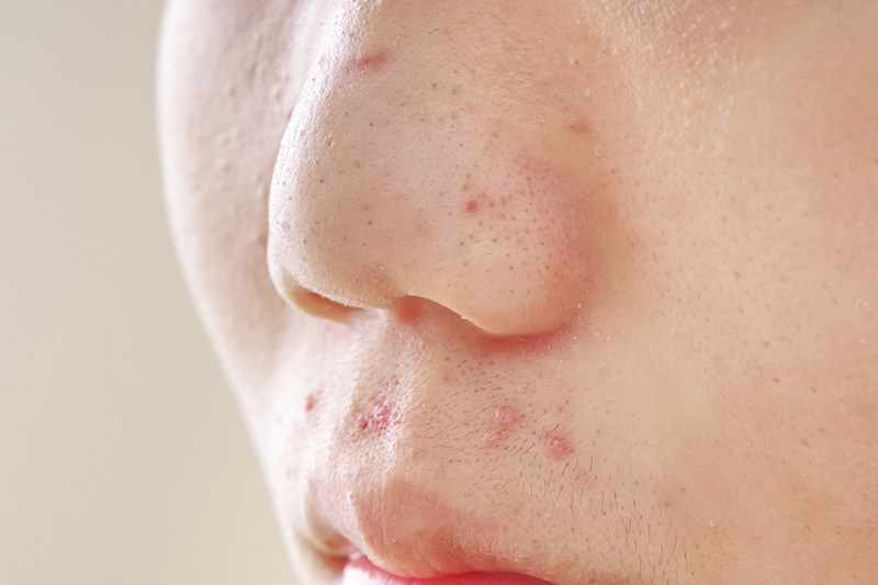 ニキビ
