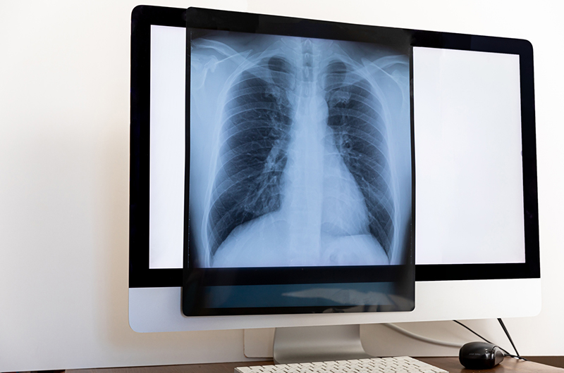 胸のレントゲン検査